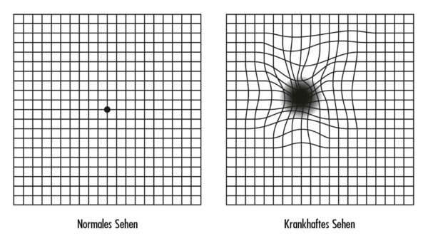 Altersbedingte_Makuladegeneration_AMD_Amsler_Test-600x338 Altersbedingte_Makuladegeneration_AMD_Amsler_Test-600x338